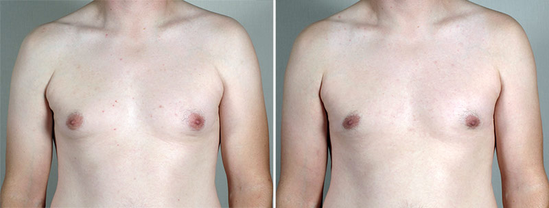 Gynecomastia Reduction Patient 54-2
