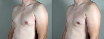 Gynecomastia Reduction Patient 54-2