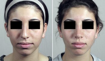 Rhinoplasty Patient 63