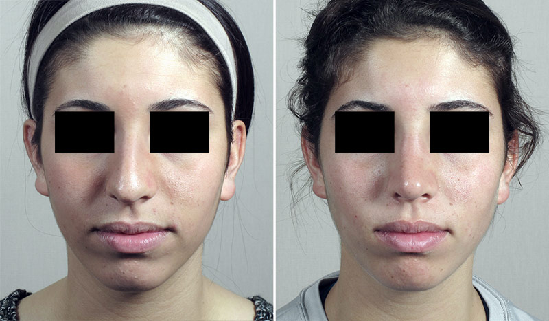 Rhinoplasty Patient 63