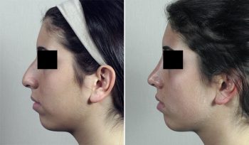 Rhinoplasty Patient 63
