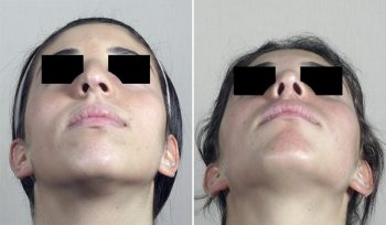 Rhinoplasty Patient 63