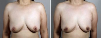 Inverted Nipple Correction Patient 12