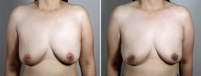 Inverted Nipple Correction Patient 12