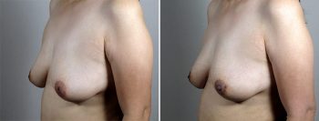 Inverted Nipple Correction Patient 12