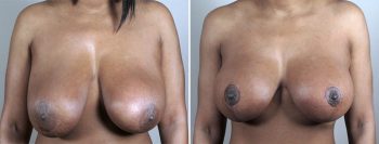 Breast Lift with Implants Patient 43
