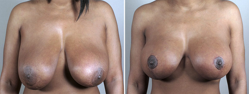 Breast Lift with Implants Patient 43