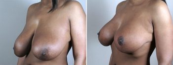 Breast Lift with Implants Patient 43