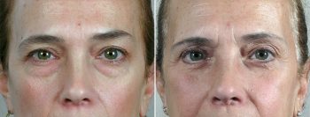 Lower Eyelid Lift Patient 40