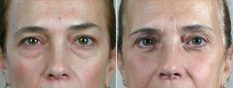 Lower Eyelid Lift Patient 40