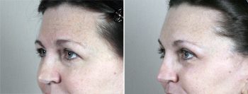 Browlift & Upper Eyelid Lift Patient 22
