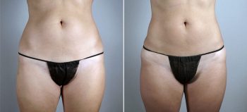Liposuction of the Hips Patient 29