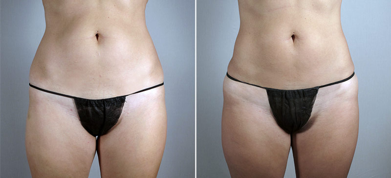 Liposuction of the Hips Patient 29