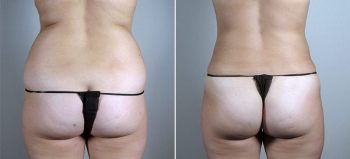 Liposuction of the Hips Patient 29