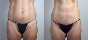 Mini Tummy Tuck 20