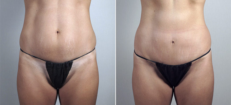 Mini Tummy Tuck 20