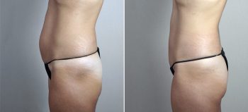 Mini Tummy Tuck 20