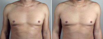 Male Nipple Reduction 2