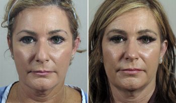 Rhinoplasty Patient 64