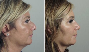 Rhinoplasty Patient 64