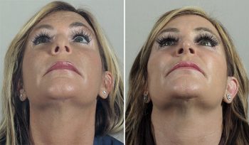 Rhinoplasty Patient 64