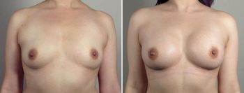 Breast Enlargement (Augmentation) Patient 97