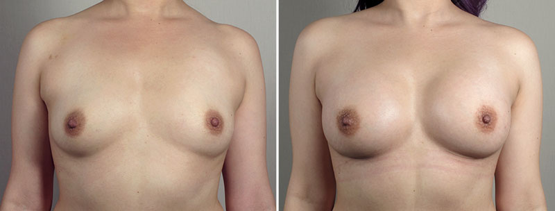 Breast Enlargement (Augmentation) Patient 97