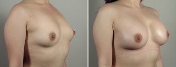 Breast Enlargement (Augmentation) Patient 97