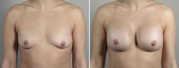 Breast Enlargement (Augmentation) Patient 98