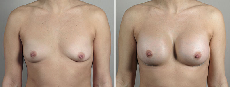 Breast Enlargement (Augmentation) Patient 98