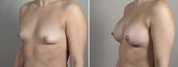 Breast Enlargement (Augmentation) Patient 98