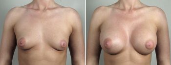 Breast Enlargement (Augmentation) Patient 96