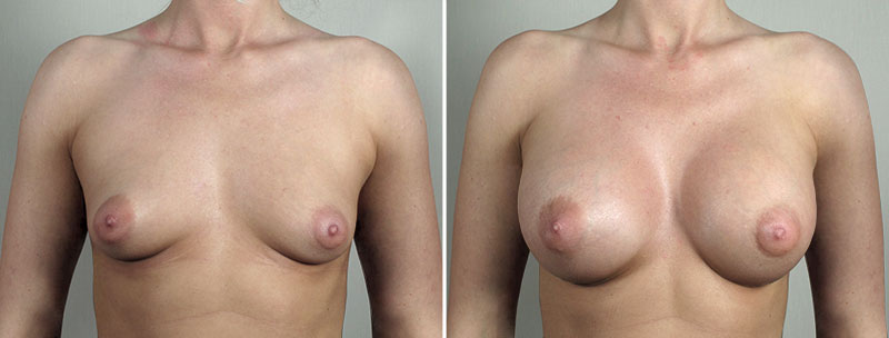 Breast Enlargement (Augmentation) Patient 96