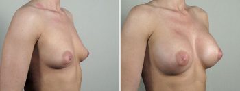 Breast Enlargement (Augmentation) Patient 96