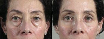 Upper & Lower Eyelid Lift Patient 17