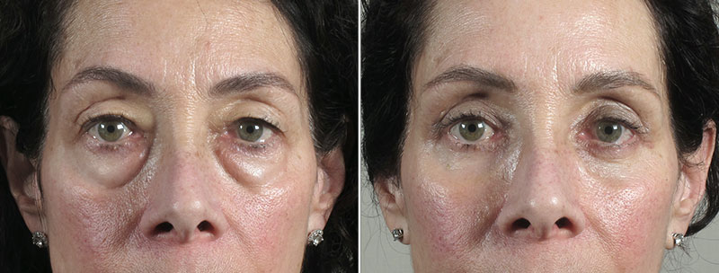 Upper & Lower Eyelid Lift Patient 17
