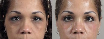 Upper & Lower Eyelid Lift Patient 18