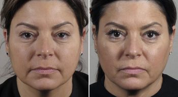Parker Rejuvenation Lift Patient 1