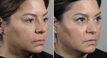 Parker Rejuvenation Lift Patient 1