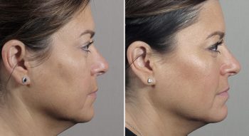 Parker Rejuvenation Lift Patient 1