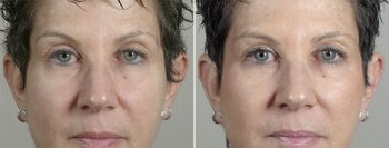 Angela’s Patient 20 – Fillers