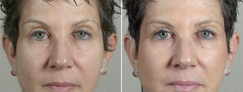 Angela’s Patient 20 – Fillers