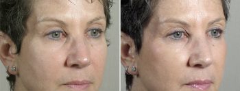 Angela’s Patient 20 – Fillers