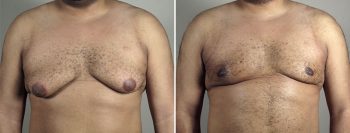 Gynecomastia Reduction Patient 54