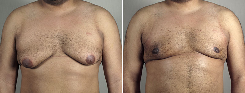Gynecomastia Reduction Patient 54