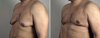 Gynecomastia Reduction Patient 54