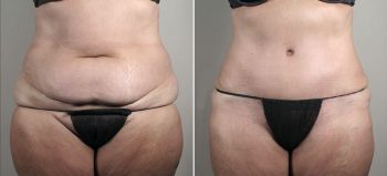 Parker Tummy Tuck Patient 53