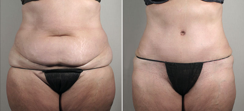 Parker Tummy Tuck Patient 53