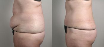 Parker Tummy Tuck Patient 53
