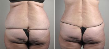 Parker Tummy Tuck Patient 53